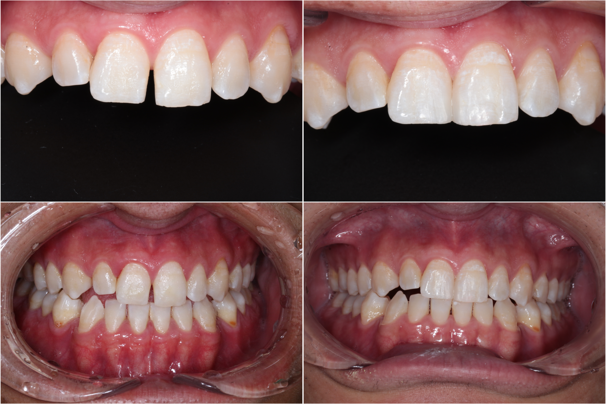 削らず治す、すきっぱ治療「ダイレクトボンド」とは？